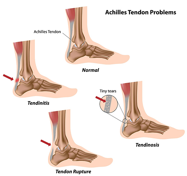 The Foot and Ankle Center of Issaquah | Fungal Nails, Flat Feet and Plantar Fasciitis