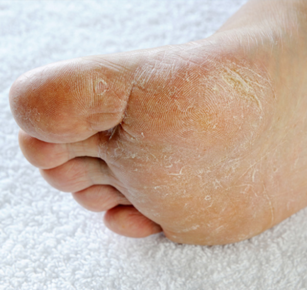 The Foot and Ankle Center of Issaquah | Plantar Fasciitis, Foot Surgery and Hammertoe