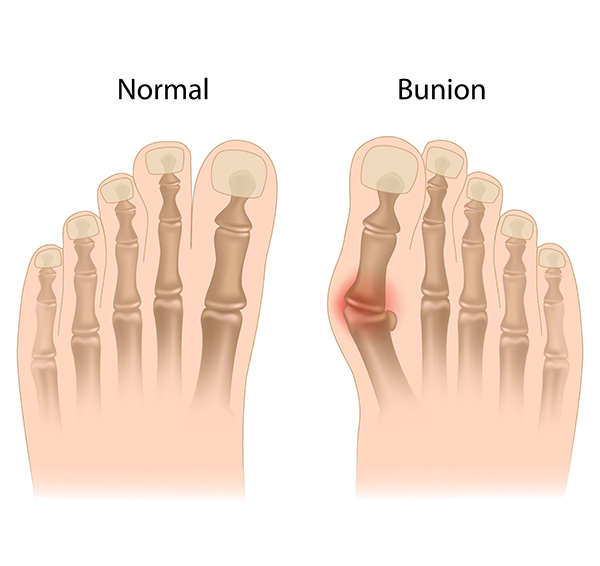 The Foot and Ankle Center of Issaquah | Athlete s Foot, Hammertoe and Plantar Fasciitis