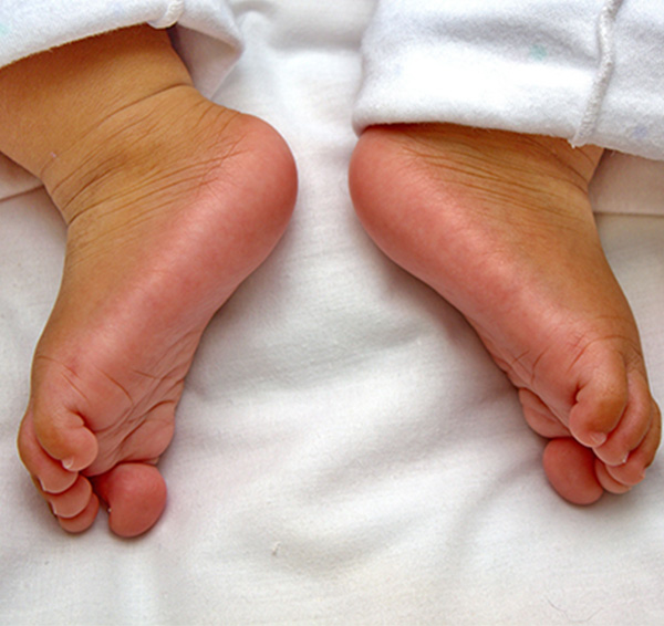 The Foot and Ankle Center of Issaquah | Bunions, Corns and Calluses and Flat Feet